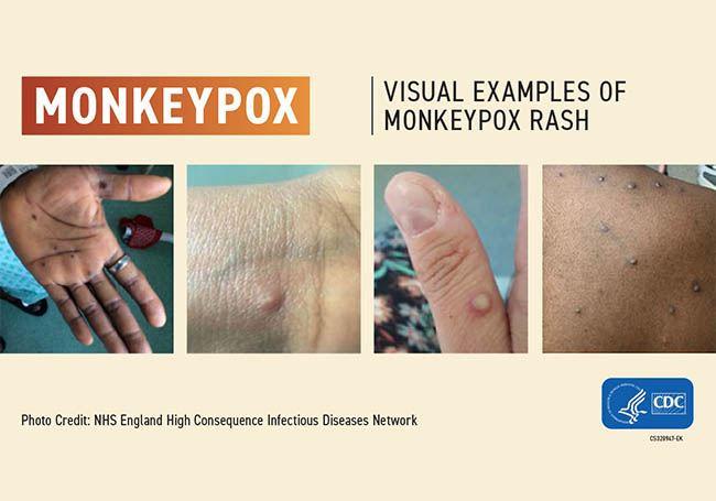 Monkeypox is an international health emergency declares WHO