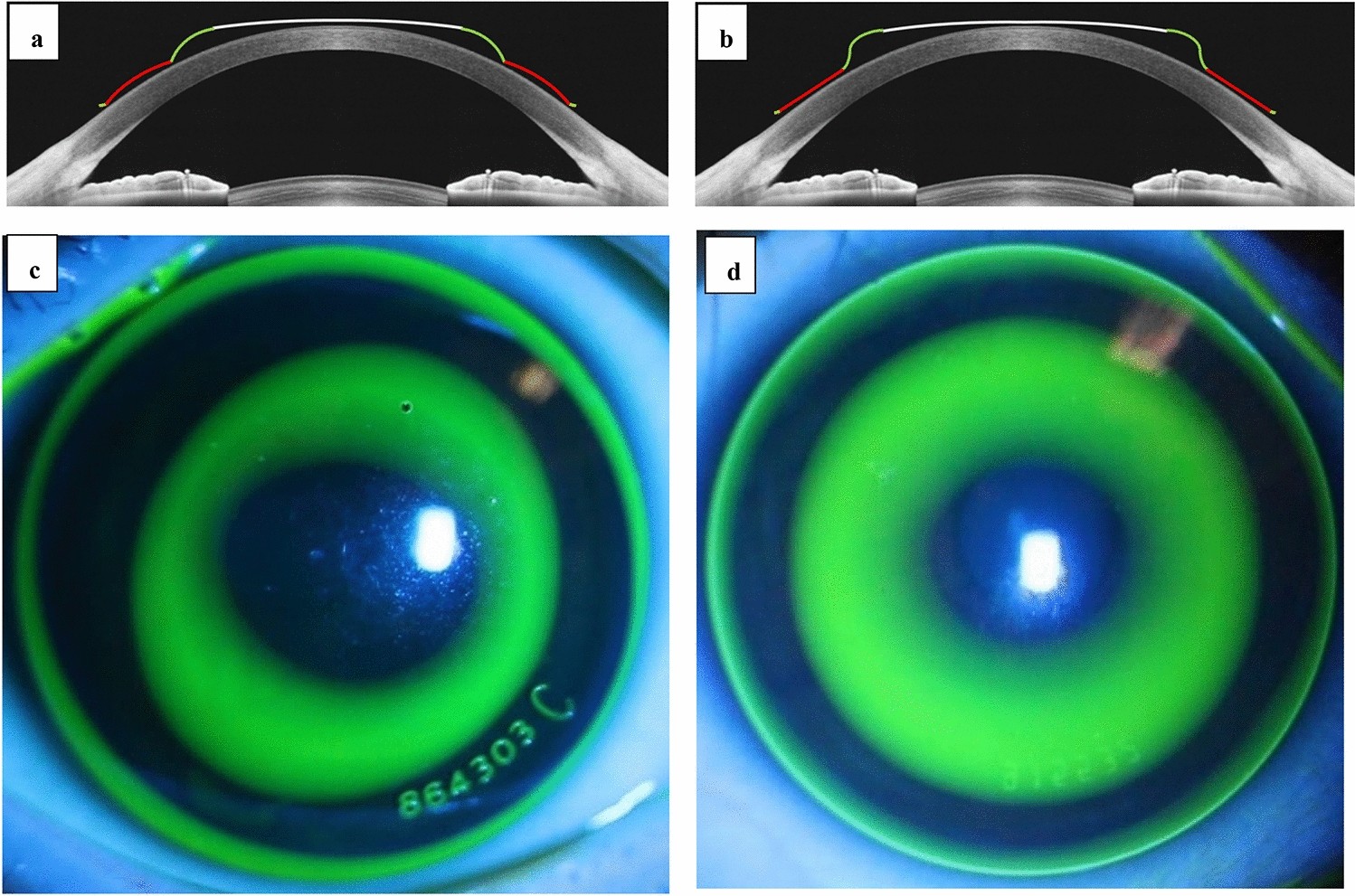 Vision Space addressing concerns on Myopia with Ortho-K